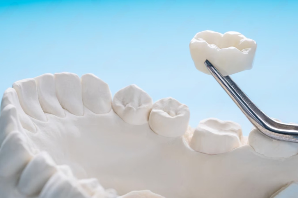 modelo dental colocacion corona diente ceramica
